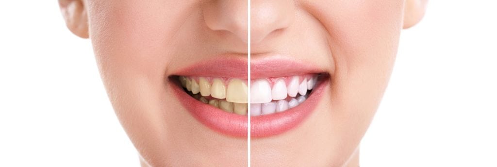 Zweigeteiltes Lächeln - Vor und nach Bleaching / Professionelle Zahnaufhellung