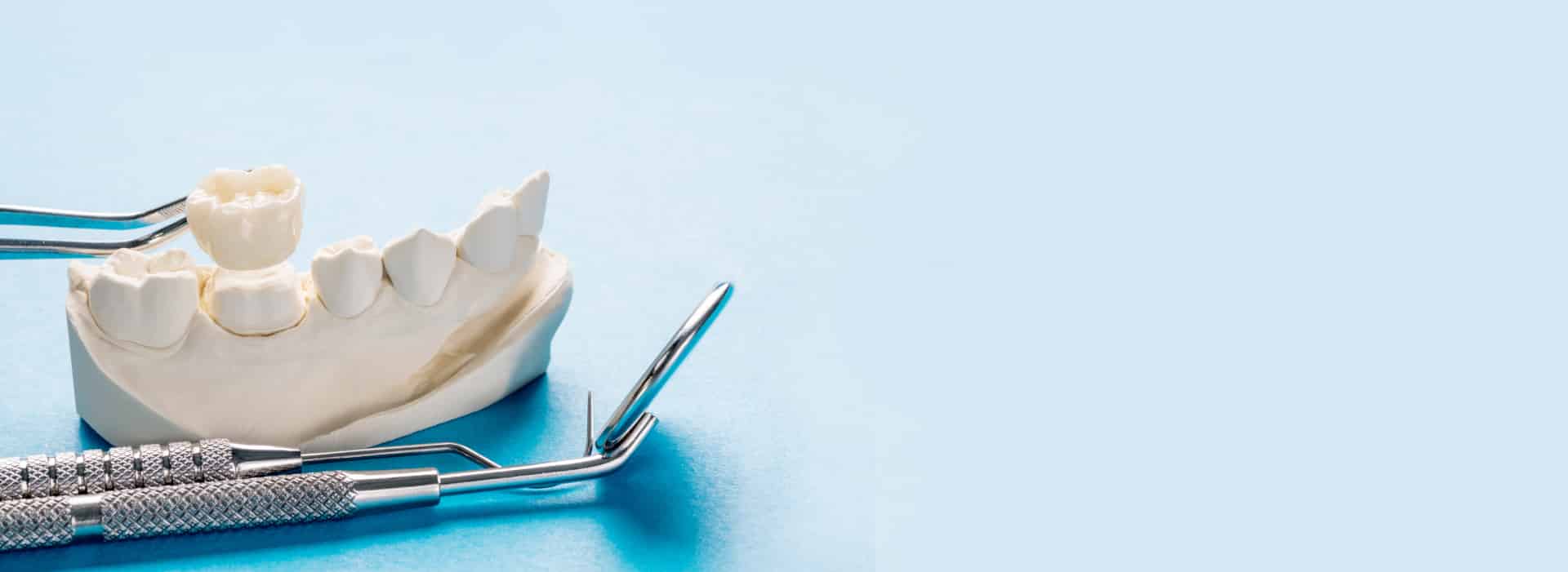 Zahnersatz Prothetik - Zahnkrone auf Zahnmodell